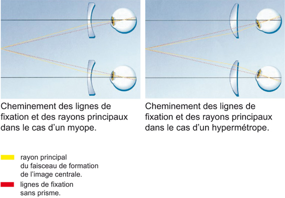 Lignes de fixation myopie et hypermétropie